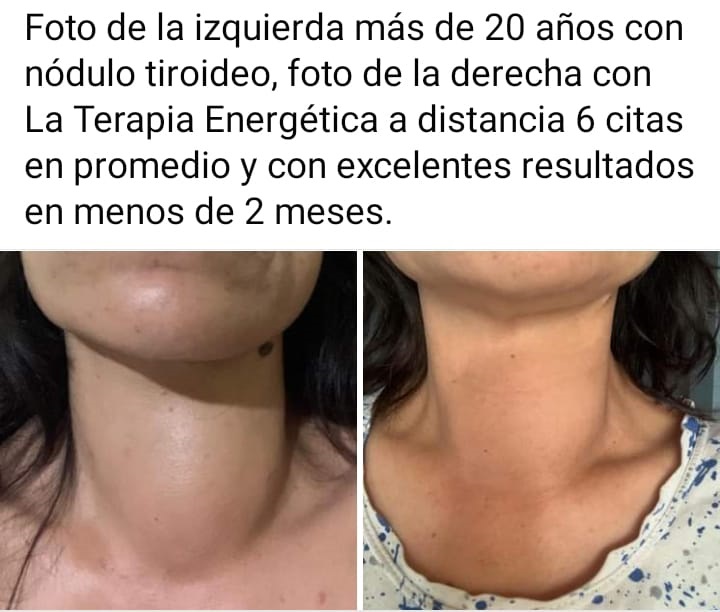 Técnica Energética a distancia, 6 citas en promedio, más de 20 años con nódulo tiroideo y mucho malestar.