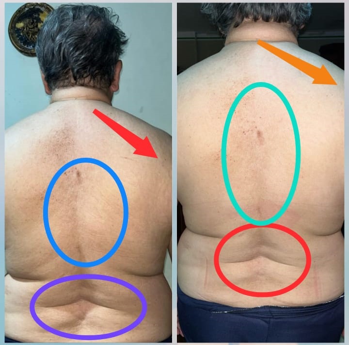 47 DÍAS. A la izq 21.12.2023 y a la derecha 5.02.2024. 6 citas a distancia, la mejoría es muy notoria y la persona necesita un poco más de terapia