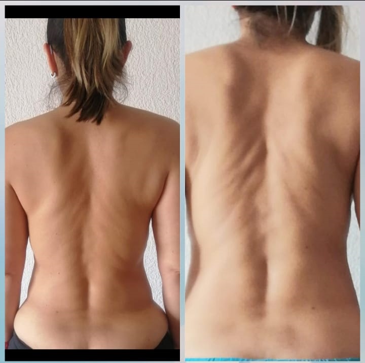 51 años, 6 citas a distancia, hiper lordosis, disminuyó un poco la inflamación de la espalda alta, ha vivido sin ningún dolor, la vida personal y profesional bloqueada, persona con profundo drama personal