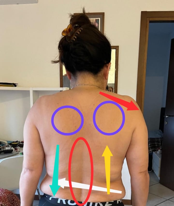 Paciente a distancia, 6 sesiones, mayo de 2024,  sin molestias físicas, espalda inflamada, las complicaciones son de nivel emocional, mira la vida de mejor manera y todo empezó a mejorar.