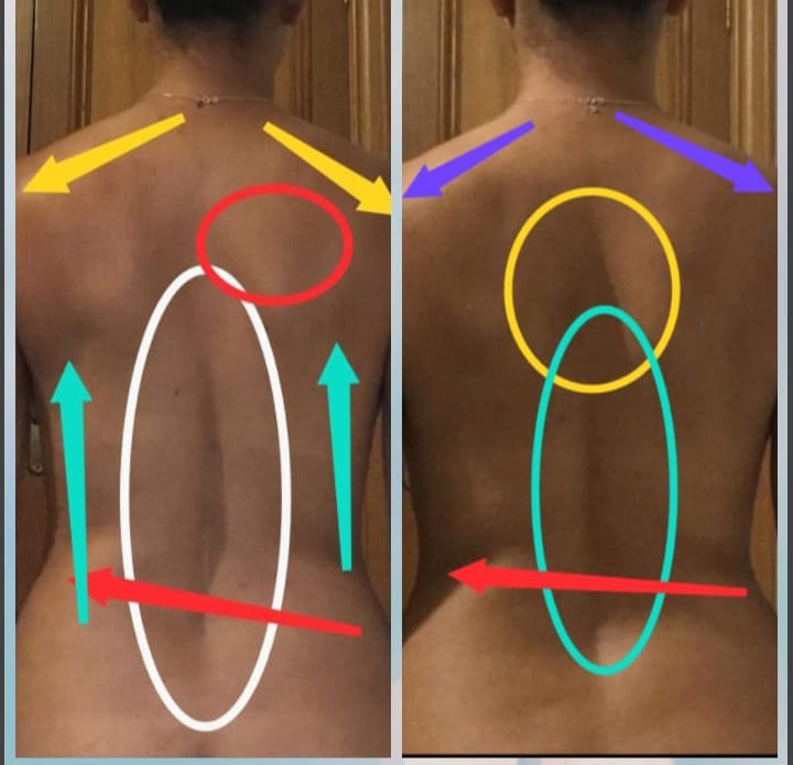 Escoliosis lumbar y dorso cervical, la foto de la izq fue 9 de agosto y la de la derecha 21 de septiembre 2023, terapia a distancia 6 citas en promedio y la mejoría es muy notable.